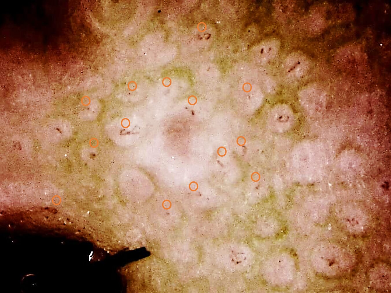[Capillaro]血管密度（Capillary Density）